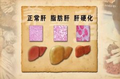 健康！紅酒竟是脂肪肝“天敵”
